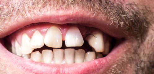Gap left after tooth extraction